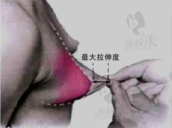 如何选择适合自己的假体形状？确定乳房皮肤的松弛度