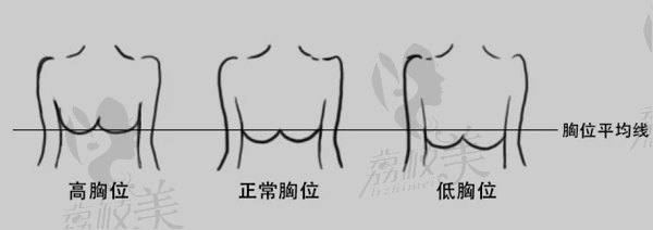 如何选择适合自己的假体形状？胸位 身材