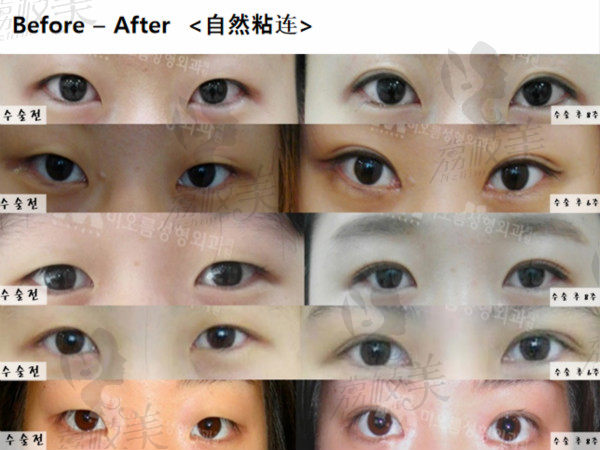 韩国美思科整形医院徐广锡双眼皮效果对比