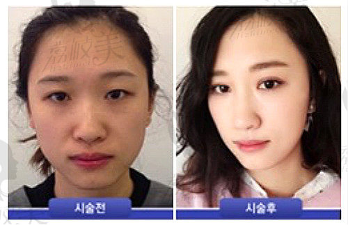 韩国111整形外科医院面部吸脂术前术后效果图
