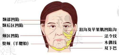 北京四惠中医医院姚乃君解析面部提升术