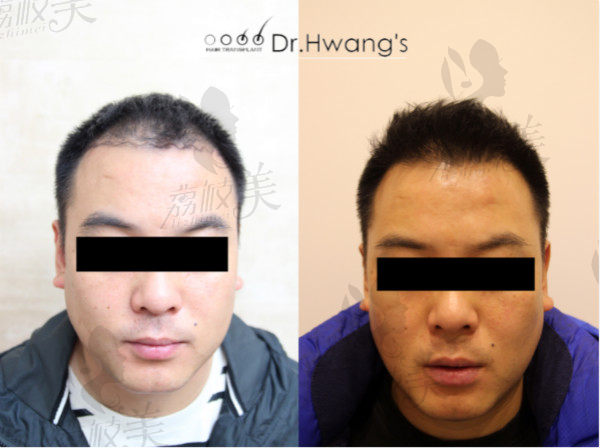 韩国黄盛柱毛发皮肤医院黄盛柱院长男士发际线前后对比效果