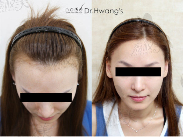韩国黄盛柱毛发皮肤医院黄盛柱院长女士发际线前后对比效果