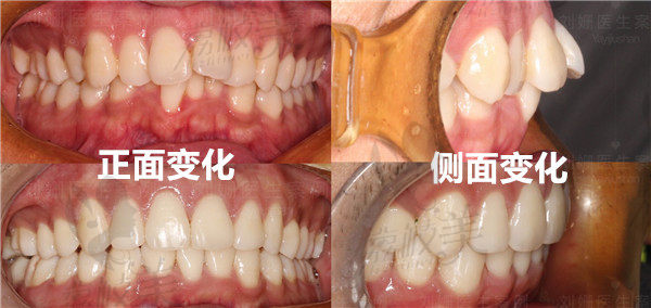 正畸前后我牙齿正面侧面的变化