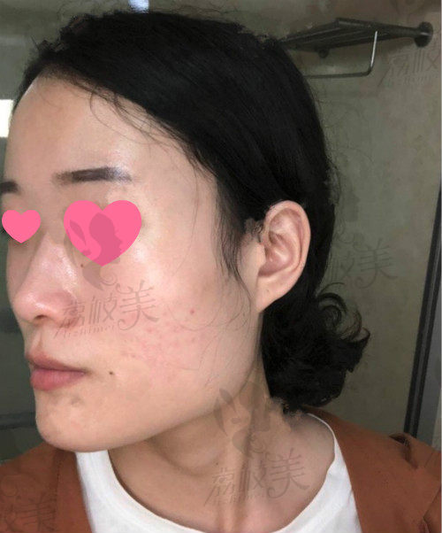 术后真实小V脸推荐-上海美联臣金振珸院长的下颌角缩小+颧骨缩小记录！