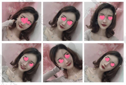 术后真实小V脸推荐-上海美联臣金振珸院长的下颌角缩小+颧骨缩小记录！