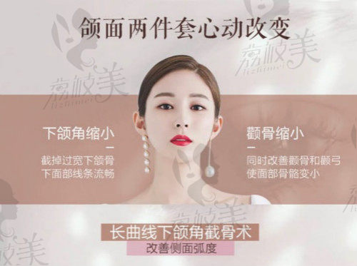 术后真实小V脸推荐-上海美联臣金振珸院长的下颌角缩小+颧骨缩小记录！