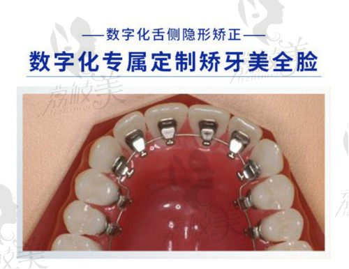 维乐口腔舌侧隐形矫正 改善突嘴龅牙-深覆合-地包天-牙齿不齐