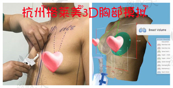 杭州格莱美隆胸术前3D模拟设计