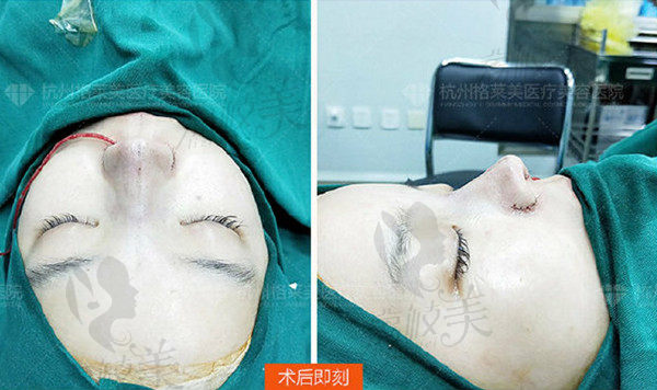 杭州格莱美汪云锋隆鼻术后即刻