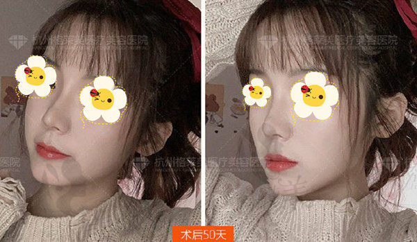 杭州格莱美汪云锋隆鼻术后50天