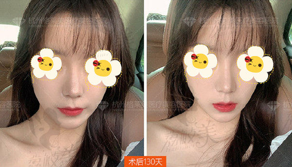 杭州格莱美汪云锋隆鼻术后130天