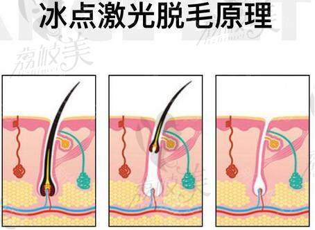 上海驻颜光医疗美容，私密激光冰点脱毛原理