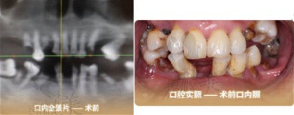 北京中诺口腔检查杨女士术前口腔情况