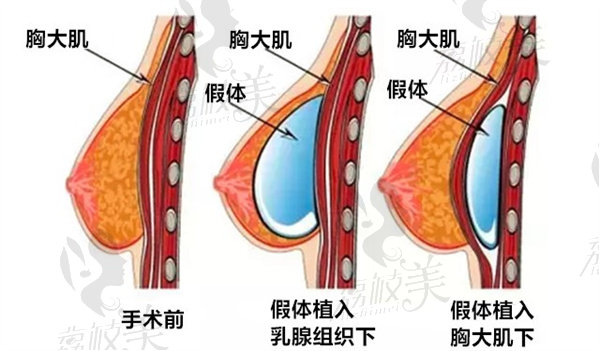 假體隆胸的手術(shù)方式