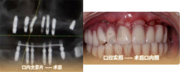 杨女士牙周炎牙齿种植术后状态