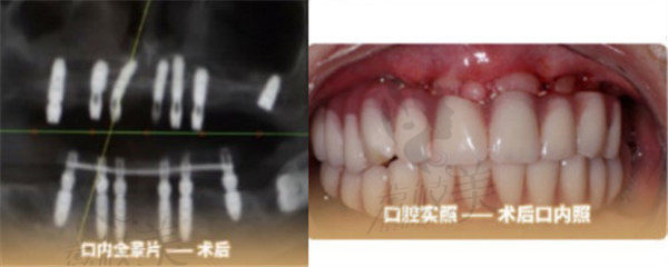 楊女士牙周炎牙齒種植術后狀態(tài)