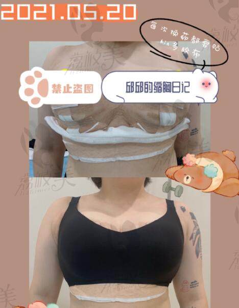 重庆星荣整形巨乳缩小手术术后对比