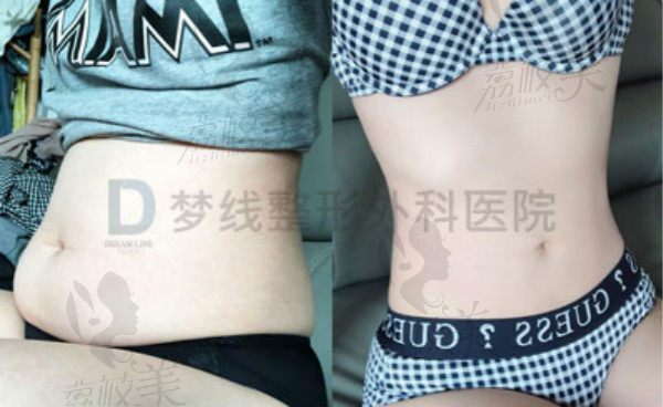 韩国dreamline梦线塑体整形代崔原赫院长腰腹吸脂效果对比吸脂