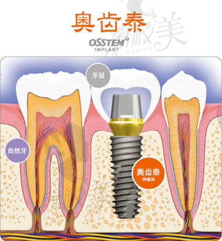 韓國奧齒泰種植體