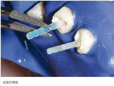 纤维桩修复缺损牙