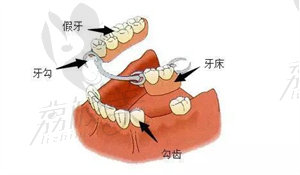 修复方法一：活动假牙