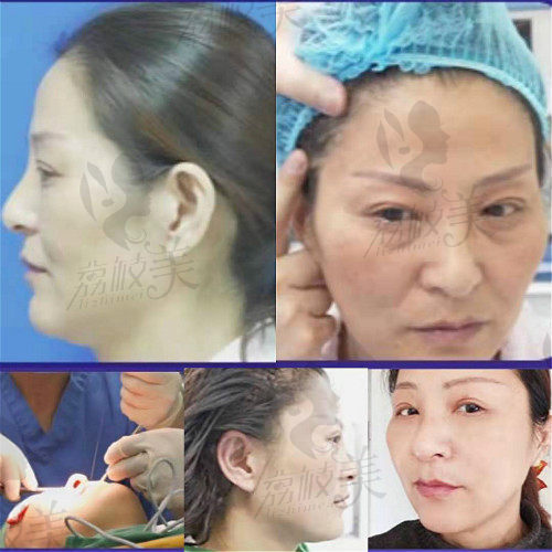 北京煤医王驰针对25岁的TER时光定格拉皮除皱术前术后效果图