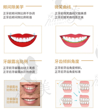 微創(chuàng)正牙可改善問題