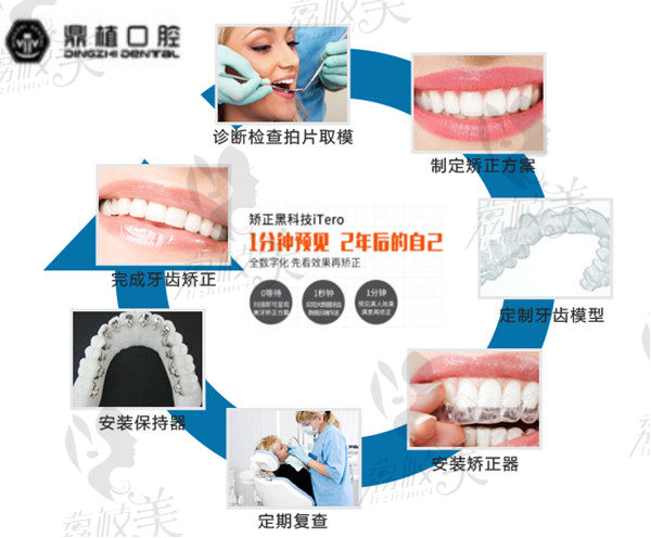 上海鼎植数字化牙齿矫正过程