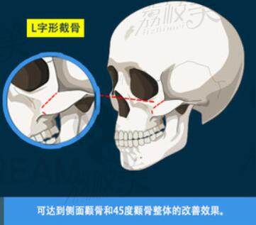 韩国DR.朵颧骨缩小术（L字型截骨）