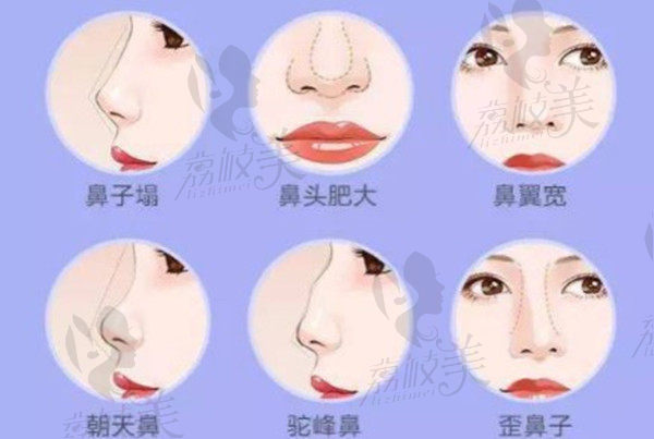 需要做隆鼻手术的鼻子特征