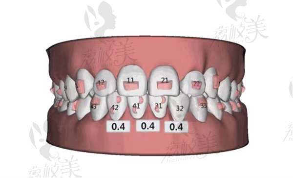 舌側(cè)矯正數(shù)據(jù)矯正