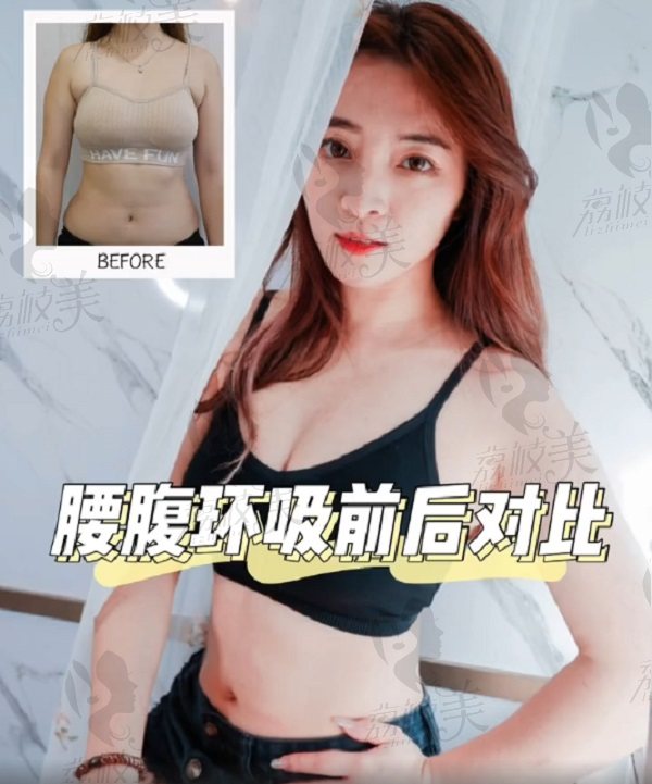 杭州格莱美彭涛腰腹吸脂对比图