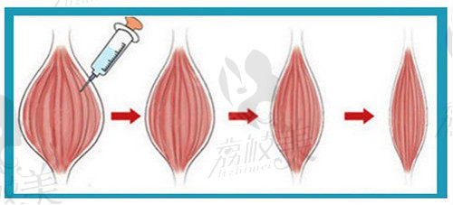 肉 毒 素对肌肉的改变示意图