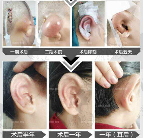 西安国 际郭树忠教授做的耳再造术后一年效果图