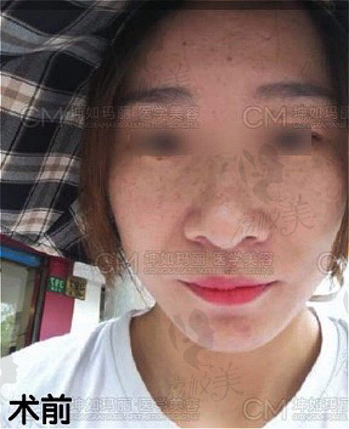 我祛雀斑之前脸部状态效果