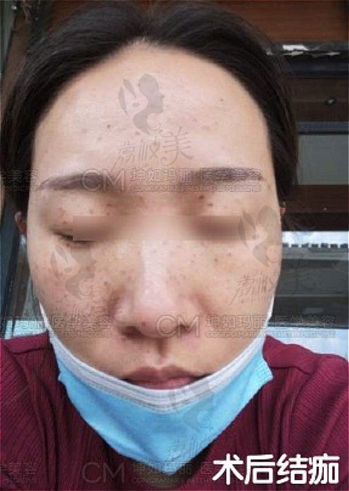 在天津坤如玛丽做的黄金超皮秒术后的结痂图