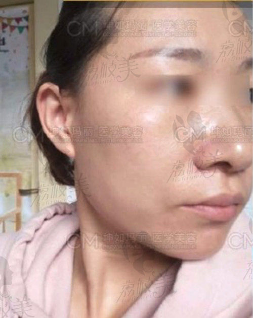 天津坤如玛丽60天术后真实祛斑效果图