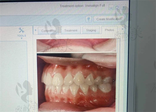 确认治疗后医生会拍牙片和取牙模。