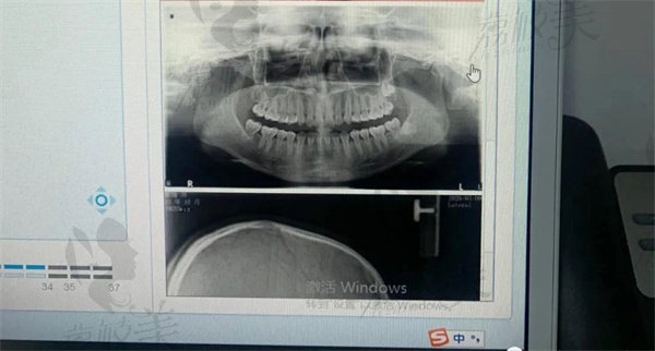 确认治疗后医生会拍牙片和取牙模