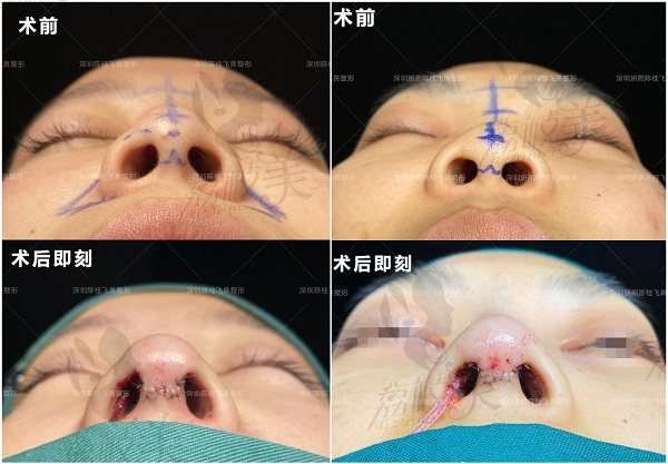 深圳妍熙陈桂飞鼻整形术后即刻对比