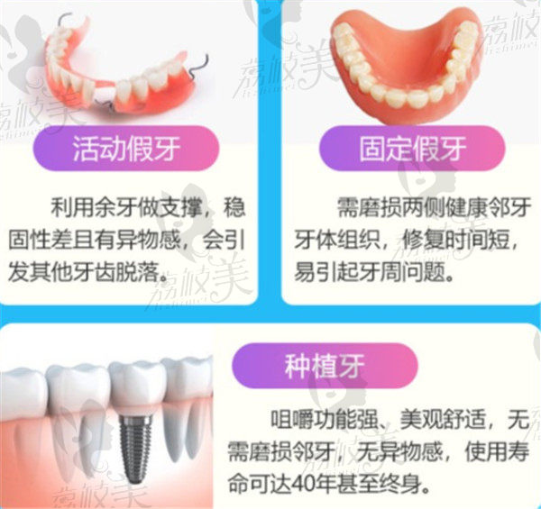 种植牙效果优于活动假牙和固定假牙
