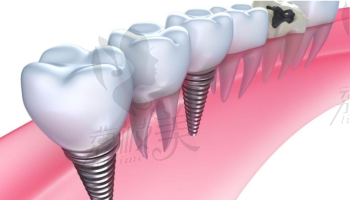 北京佳美口腔種植牙