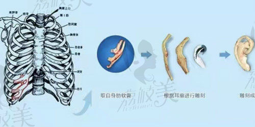 北京煤医自体软骨耳再造取肋过程图