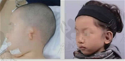 北京煤医郭志华的Medpor假体生物支架耳再造术后对比