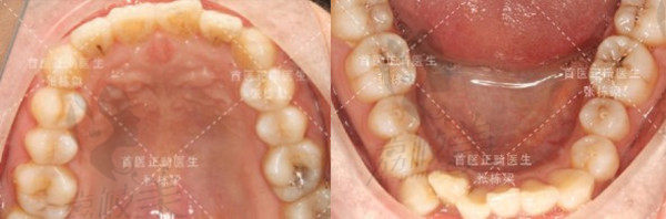 牙齿矫正前的口腔检查结果