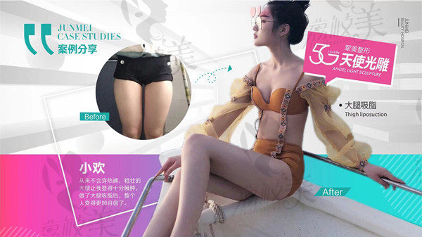 重庆军美大腿吸脂术后效果