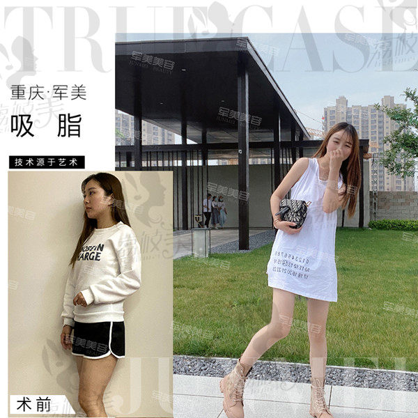 重庆军美大腿吸脂术后效果
