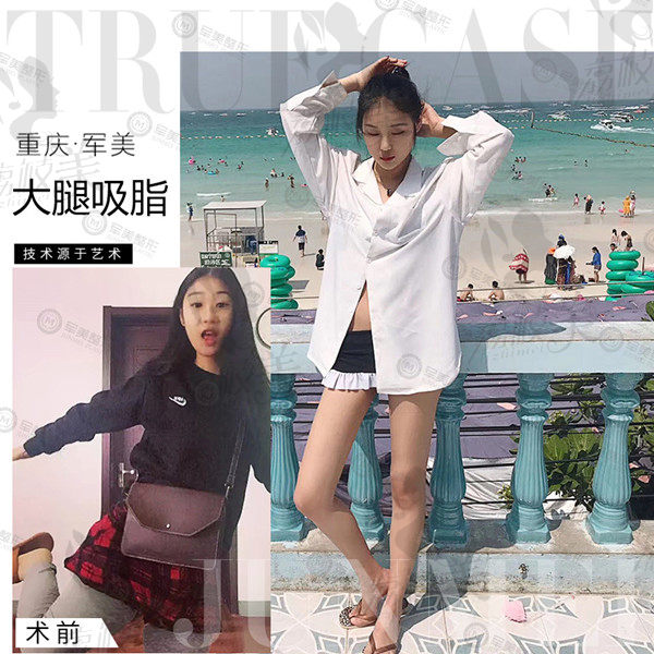 重庆军美大腿吸脂术后效果