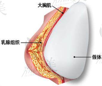 韩国DR.朵整形假体隆胸